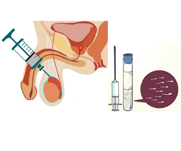 Surgical Sperm Retrieval Tesa/Pesa Treatment in Mumbai at Fertility Square IVF Clinic